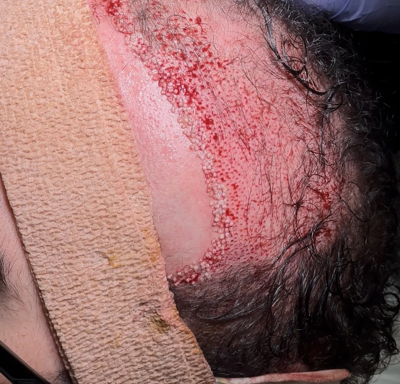 Close-up of skin showing rash with red bumps and texture variation on facial area